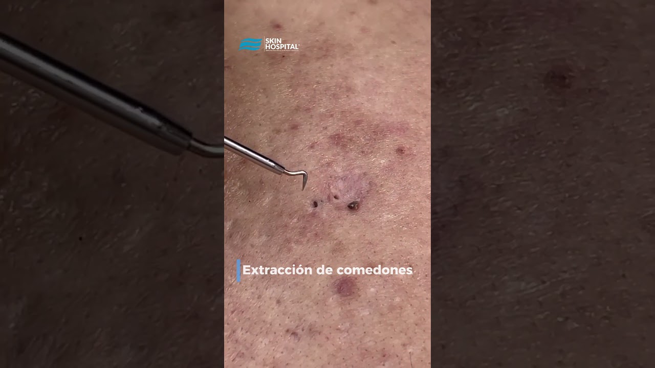 extraccion de granos en la cara